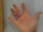 Arnica montana for dislocated fingers (with pictures)